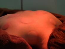 カーム(Calm)/吸玉