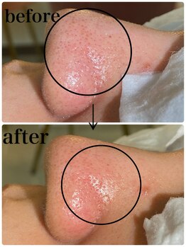 毛穴専科/ワックス脱毛メンズok/沖縄/那覇