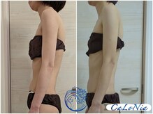 カロニア(CaLoNia)/猫背・巻き肩解消