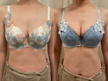 ハイファイブ(Hi-Five)/バストアップ/（施術8回）