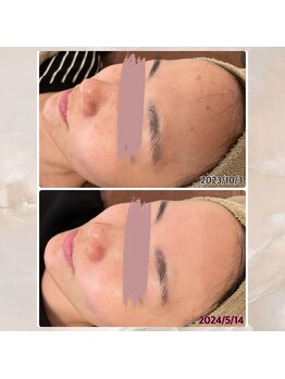 プルーム 大橋店(plume)/ハーブピーリング