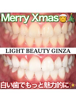 ライトビューティー 銀座店(LightBeauty)/東銀座 ホワイトニング 症例写真