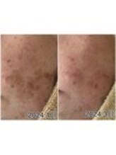 アップル 御幸ヶ原店(Apple.)/肌改善プログラム