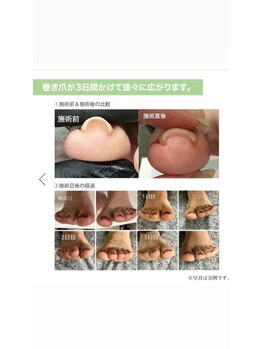 巻爪を広げてくれるベースジェル