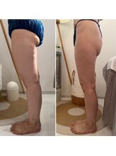 サロンドプレマージュ(Salon de Premage)/脂肪冷却&ラフォスプレミアム