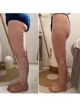 サロンドプレマージュ(Salon de Premage)/脂肪冷却&ラフォスプレミアム