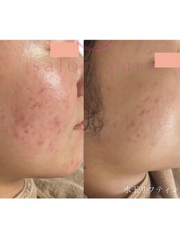 毛穴専科の写真/【ニキビケアで艶肌爆誕】剥離なしの天然ハーブピーリングが破格の￥5,000♪黒ずみやニキビを根本改善！