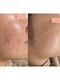 毛穴専科の写真/【ニキビケアで艶肌爆誕】剥離なしの天然ハーブピーリングが破格の￥5,000♪黒ずみやニキビを根本改善！