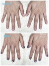 深爪矯正×マグネット