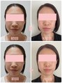 カナエル(QANAEL) フェイシャルメニューとグローパックをしたお写真です♪