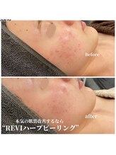 サロン ド リリー(salon de lily)/REVIハーブピーリング