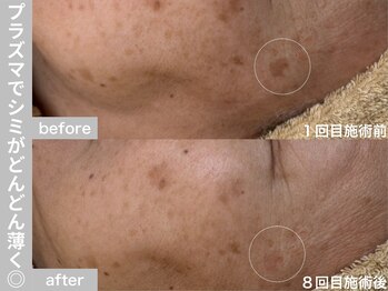 サロン ビュー(salon view)/60代女性〈シミ悩み〉