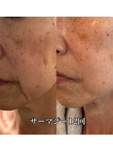 エステサロン ベリシモ(Bellissimo)/フェイシャル/ビフォーアフター