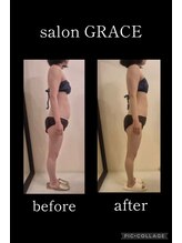 サロン グレイス(salon GRACE)/産後エステ1回ビフォーアフター