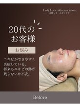 レディラック 大阪梅田本店(Lady Luck)/ニキビ改善集中コース