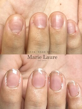 マリーロール 梅田店(Marie Laure)/自爪育成/深爪矯正/ネイルケア