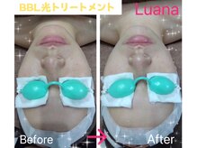 ルアナ(Luana)/お肌のお悩み一気に改善(^^)
