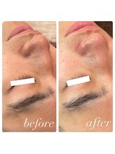 ラディエンス 多治見店/メンズ毛穴エステ