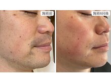 トパーズ 藤枝店(Topaz)の雰囲気（ひげ脱毛 ビフォーアフター写真はフォト一覧へ 全身脱毛もお得）