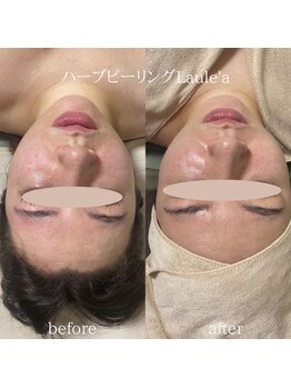 ラウレア/ハーブピーリング×小顔