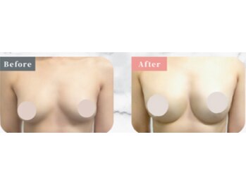 ベッピン(Beppin)/バストアップ症例写真