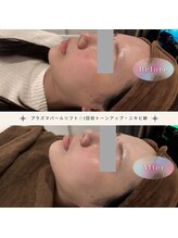 ディアー(Dear)/プラズマパールリフト