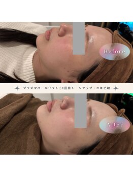 ディアー(Dear)/プラズマパールリフト