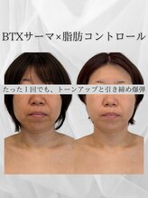 サロン ド ナース ユー ソナ(salon de nurse U.sona)/RF力！！ほうれい線まわり激変