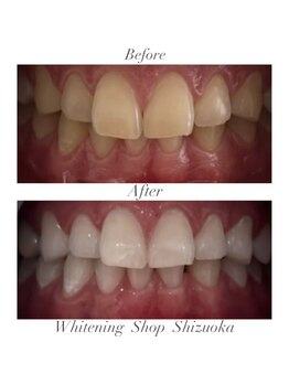 ホワイトニングショップ 静岡店/ホワイトニングBefore→After