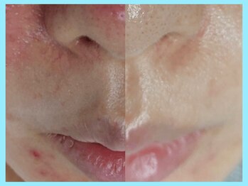 ハーブピーリング 名古屋/ララピール 導入★