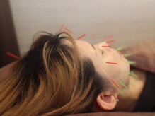 三国ヶ丘鍼灸整骨院/三国ケ丘産後整体/美容鍼灸