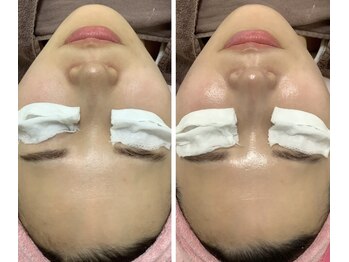 ルル(RuRu)/W水光ピール