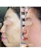 ラウレア/ハーブピーリング×小顔