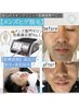 【メンズ脱毛☆髭脱毛】高出力脱毛機で髭を撃退！IPLフェイシャルで美肌に☆