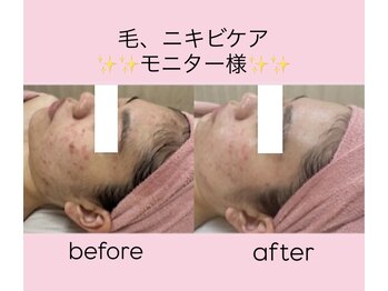 エステティック　レイビス 渋谷店(RAYVIS)/顔脱毛×フェイシャルニキビケア