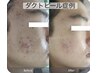 【北九州初導入店☆】20代~30代(男女OK)悩み肌改善 !ダクトピール60分