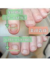 マニエネイル(mani e nail)/足爪の深爪矯正もできます