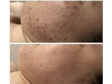 ライジング 熊本菊陽光の森店(RISING)の雰囲気（ニキビ施術6回目の結果）