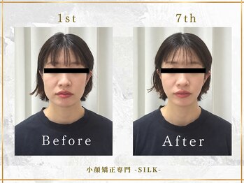 シルク(SILK)の写真/★顔の悩みに専門の小顔サロン★小顔だけでなく「エラ張り」「たるみ」「左右差」など顔の悩み改善まで◎