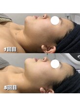 ディメンション 大里店(DIMENSION)/小顔エステ コース5回目