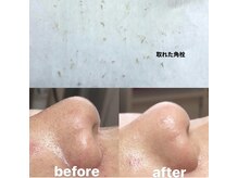 ビューティーネイル(Beauty Nail)/毛穴エクストラクション