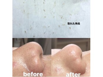 ビューティーネイル(Beauty Nail)/毛穴エクストラクション