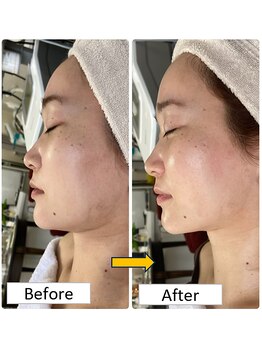 チェリオール(Cherioll)/ウィンバック小顔フェイシャル