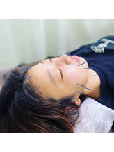 ヒューマン鍼灸接骨院/少ない本数で効果◎の美容鍼♪
