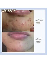 エステティック レイビス 銀座店(RAYVIS)/ニギビケア