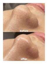 プティジョナ(Petit Jona)/大人気♪ハイドロ毛穴洗浄♪