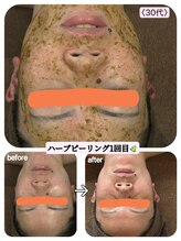 ワンバイゼロ(One by zero)/ハーブピーリング×グロッティ