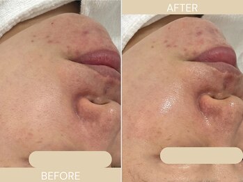 エクラ(eclat)/施術回数:1回