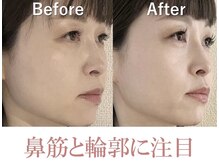 ラプリ 盛岡店(Raplit)/隆鼻＋輪郭矯正40分10回