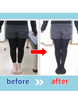 ストレッチヒーロー 鳥取店(STRETCH HERO)/O脚/X脚